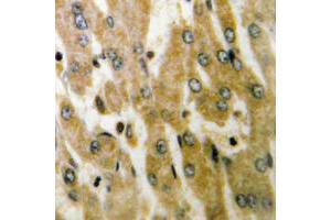 Immunohistochemical analysis of ACOT4 staining in human liver cancer formalin fixed paraffin embedded tissue section. (ACOT4 抗体  (C-Term))