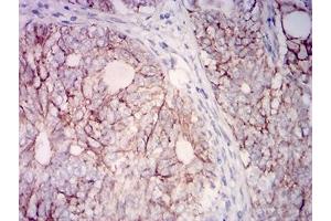 Immunohistochemical analysis of paraffin-embedded cervical cancer tissues using CD315 mouse mAb with DAB staining.