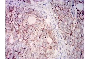 Immunohistochemical analysis of paraffin-embedded cervical cancer tissues using CD315 mouse mAb with DAB staining. (PTGFRN 抗体  (AA 46-221))