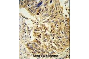 SDR Antibody (Center) (ABIN653890 and ABIN2843136) IHC analysis in formalin fixed and paraffin embedded lung carcinoma followed by peroxidase conjugation of the secondary antibody and DAB staining. (SDPR 抗体  (AA 109-135))