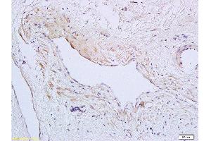 Formalin-fixed and paraffin embedded human cervical carcinoma tissue labeled with Anti-SynCAM/TSLC1 Polyclonal Antibody, Unconjugated  at 1:200 followed by conjugation to the secondary antibody and DAB staining (CADM1 抗体  (AA 365-442))
