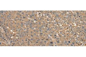 Immunohistochemistry of paraffin-embedded Human liver cancer tissue using CCDC85C Polyclonal Antibody at dilution of 1:30(x200) (CCDC85C 抗体)