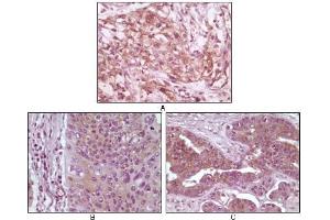 Immunohistochemical analysis of paraffin-embedded human pancreas carcinoma (A), esophagus carcinoma tissue (B) and ovary tumor tissue (C), showing cytoplasmic and membrane localization using 4E-BP1 mouse mAb with DAB staining. (eIF4EBP1 抗体)