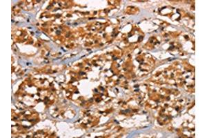 The image on the left is immunohistochemistry of paraffin-embedded Human thyroid cancer tissue using ABIN7190032(CABLES2 Antibody) at dilution 1/25, on the right is treated with synthetic peptide. (CABLES2 抗体)