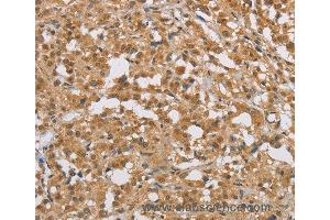 Immunohistochemistry of Human cervical cancer using DIDO1 Polyclonal Antibody at dilution of 1:50 (DIO1 抗体)
