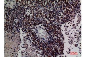 Immunohistochemistry (IHC) analysis of paraffin-embedded Human Lung Cancer, antibody was diluted at 1:100. (DCI 抗体  (C-Term))