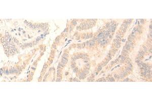Immunohistochemistry of paraffin-embedded Human thyroid cancer tissue using ADGRE3 Polyclonal Antibody at dilution of 1:35(x200) (EMR3 抗体)