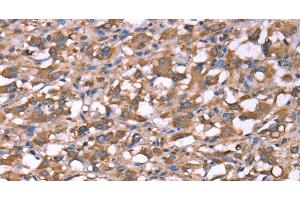 Immunohistochemistry of paraffin-embedded Human thyroid cancer tissue using SPAST Polyclonal Antibody at dilution 1:40 (Spastin 抗体)