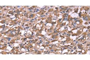 Immunohistochemistry of paraffin-embedded Human thyroid cancer tissue using SPAST Polyclonal Antibody at dilution 1:40
