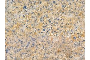 ABIN7096403 and ABIN7100467 at 1/100 staining human hepatocellular carcinoma by IHC-P. (TIMMDC1 抗体)