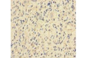 Immunohistochemistry of paraffin-embedded human glioma using ABIN7155411 at dilution of 1:100 (HIST1H2BN 抗体  (AA 2-126))
