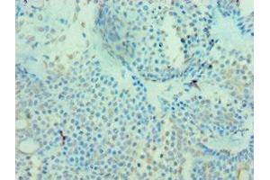 Immunohistochemistry of paraffin-embedded human breast cancer using ABIN7159680 at dilution of 1:100 (MICA 抗体  (AA 24-307))