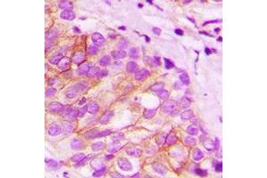 Immunohistochemical analysis of Tapasin staining in human breast cancer formalin fixed paraffin embedded tissue section. (TAPBP 抗体  (full length))