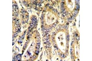 IHC analysis of FFPE human colon carcinoma stained with IGFBP6 antibody (IGFBP6 抗体  (AA 176-200))
