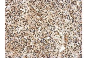 IHC-P Image Immunohistochemical analysis of paraffin-embedded AGS xenograft, using hnRNP 1, antibody at 1:500 dilution. (PTBP1 抗体)