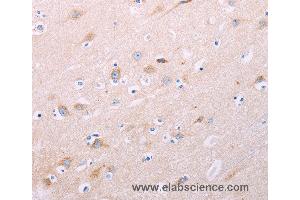 Immunohistochemistry of Human thyroid cancer using ADCY5 Polyclonal Antibody at dilution of 1:40