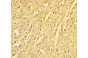 Immunohistochemistry of paraffin-embedded human melanoma using ABIN7173027 at dilution of 1:100 (TMEM19 抗体  (AA 34-83))