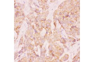 Anti-AAMP Picoband antibody,  IHC(P): Human Mammary Cancer Tissue (AAMP 抗体  (AA 235-434))