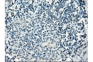 Immunohistochemical staining of paraffin-embedded Adenocarcinoma of colon tissue using anti-PDE10A mouse monoclonal antibody. (PDE10A 抗体)
