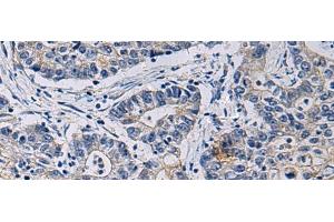 Immunohistochemistry of paraffin-embedded Human gastric cancer tissue using CHST3 Polyclonal Antibody at dilution of 1:35(x200) (CHST3 抗体)