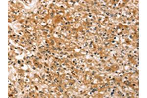 The image on the left is immunohistochemistry of paraffin-embedded Human prostate cancer tissue using ABIN7192485(SLC40A1 Antibody) at dilution 1/20, on the right is treated with synthetic peptide. (Band 3/AE1 抗体)