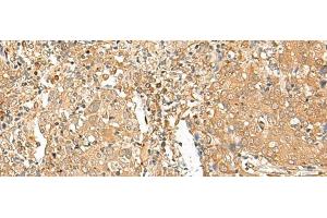 Immunohistochemistry of paraffin-embedded Human cervical cancer tissue using GOLGA6A Polyclonal Antibody at dilution of 1:50(x200) (GOLGA6A 抗体)