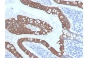 Formalin-fixed, paraffin-embedded human Colon Carcinoma stained with Cytokeratin 20 Mouse Monoclonal Antibody (KRT20/3145). (KRT20 抗体  (AA 196-323))