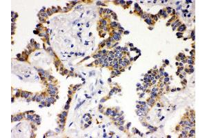 Anti- ATG14L Picoband antibody, IHC(P) IHC(P): Human Lung Cancer Tissue (ATG14 抗体  (N-Term))