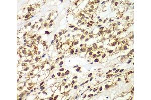 Immunohistochemistry of paraffin-embedded Human kidney cancer using SMAD9 Polyclonal Antibody at dilution of 1:100 (40x lens). (SMAD9 抗体)