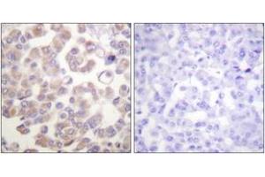 Immunohistochemistry analysis of paraffin-embedded human breast carcinoma tissue, using WNT1 Antibody. (WNT1 抗体  (AA 301-350))