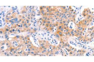 Immunohistochemistry of paraffin-embedded Human lung cancer tissue using Factor XIIIa Polyclonal Antibody at dilution 1:80