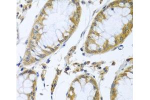 Immunohistochemistry of paraffin-embedded Human colon carcinoma using FBXL5 Polyclonal Antibody at dilution of 1:100 (40x lens). (FBXL5 抗体)