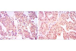Immunohistochemical analysis of paraffin-embedded breast cancer tissues (left) and ovarian cancer tissues (right) using CARM1 mouse mAb with DAB staining.