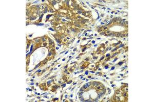 Immunohistochemistry of paraffin-embedded human gastric cancer using CDC16 antibody. (CDC16 抗体)