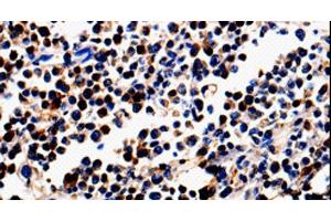 Immunohistochemistry of paraffin-embedded Human colon cancer tissue using ALOX5 Polyclonal Antibody at dilution 1:50 (ALOX5 抗体)