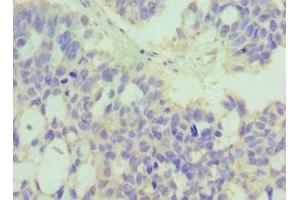 Immunohistochemistry of paraffin-embedded human endometrial cancer using ABIN7174047 at dilution of 1:100 (MERTK 抗体  (AA 840-999))
