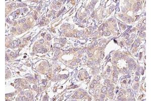 ABIN6267493 at 1/100 staining human breast carcinoma tissue sections by IHC-P. (MEK2 抗体  (pThr394))