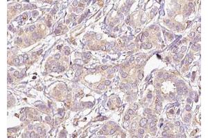 ABIN6267493 at 1/100 staining human breast carcinoma tissue sections by IHC-P.