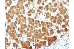 IHC testing of FFPE human melanoma with S100 beta antibody (clone S100B/1012). (S100B 抗体)