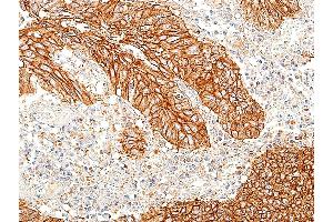 Immunohistochemistry (IHC) image for anti-Cadherin 1, Type 1, E-Cadherin (Epithelial) (CDH1) (AA 155-707) antibody (ABIN7455206)