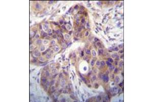 Immunohistochemical staining of formalin fixed and paraffin embedded human breast cancer was performed with KLK6 polyclonal antibody  at 1:10-1:50 dilution followed by indirect peroxidase conjugation with secondary antibody and DAB staining.