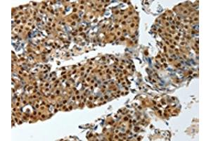 The image on the left is immunohistochemistry of paraffin-embedded Human breast cancer tissue using ABIN7193081(YBX1 Antibody) at dilution 1/15, on the right is treated with synthetic peptide.