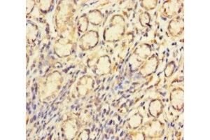 Immunohistochemistry of paraffin-embedded human gastric cancer using ABIN7148710 at dilution of 1:100 (CTDNEP1A 抗体  (AA 3-244))