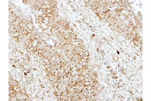 IHC-P Image Immunohistochemical analysis of paraffin-embedded human breast cancer, using EEN, antibody at 1:250 dilution. (SH3GL1 抗体  (Center))