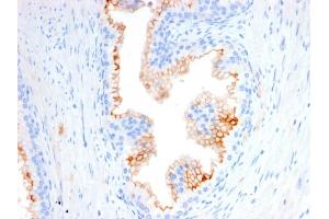 Formalin-fixed, paraffin-embedded human Prostate Carcinoma stained with CD10 Mouse Monoclonal Antibody (MME/2580).