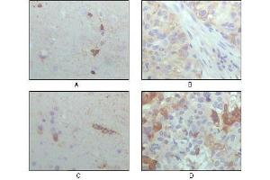 Immunohistochemical analysis of paraffin-embedded human brain hippocampus (A), lung cancer (B), brain tumor (C), breast cance (D), showing cytoplasmic localization with DAB staining using CRYAB antibody. (CRYAB 抗体  (AA 1-175))