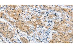 Immunohistochemistry of paraffin-embedded Human gastric cancer using HSP40 Polyclonal Antibody at dilution of 1:40 (DNAJB1 抗体)