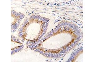 IHC analysis of FFPE human colon carcinoma tissue stained with GDF11 antibody