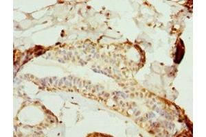 Immunohistochemistry of paraffin-embedded human breast cancer using ABIN7169124 at dilution of 1:100 (Nemo-Like Kinase 抗体  (AA 278-527))