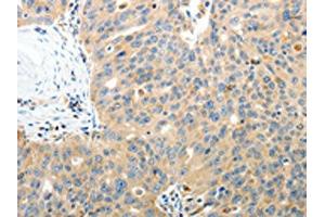 The image on the left is immunohistochemistry of paraffin-embedded Human ovarian cancer tissue using ABIN7130809(RAMP3 Antibody) at dilution 1/40, on the right is treated with fusion protein. (RAMP3 抗体)